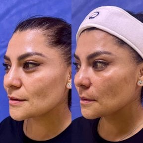 before-after photo botoks-dlya-polovogo-chlena
