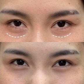 Before and after lower eyelid blepharoplasty results at Somchai Clinic, reduced eye bags