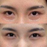 Before and after lower eyelid blepharoplasty results at Somchai Clinic, reduced eye bags