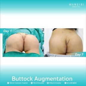 before-after photo rhinoplasty-nose-job