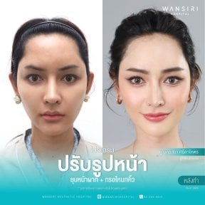 before-after photo sex-reassignment-surgery