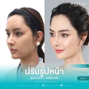 before-after photo sex-reassignment-surgery