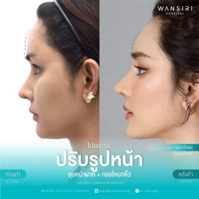 before-after photo sex-reassignment-surgery