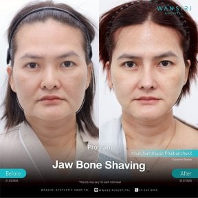 before-after photo sex-reassignment-surgery