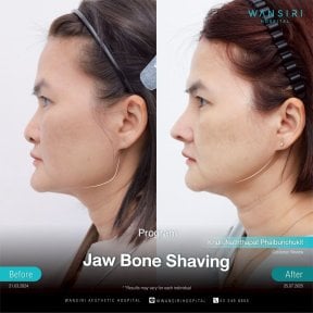 before-after photo sex-reassignment-surgery