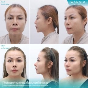 before-after photo sex-reassignment-surgery