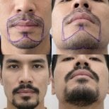 نتائج زراعة شعر اللحية قبل وبعد في قسم الجلد والجراحة - مستشفى نافامين9