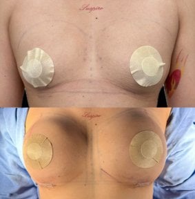 before-after photo uvelicenie-grudi