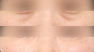 before-after photo lower-eyelid-surgery