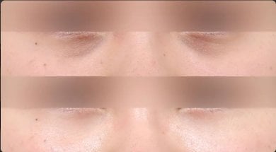 before-after photo lower-eyelid-surgery