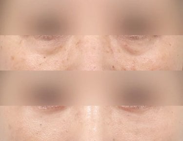 before-after photo lower-eyelid-surgery