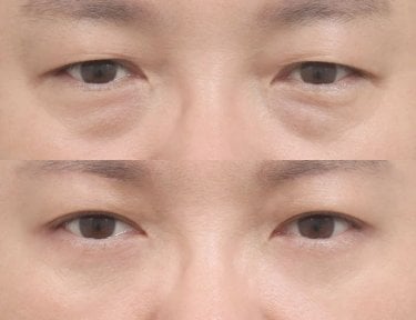 before-after photo lower-eyelid-surgery