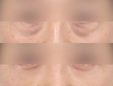 before-after photo lower-eyelid-surgery