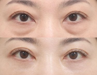 before-after photo lower-eyelid-surgery