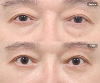 before-after photo lower-eyelid-surgery