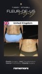 Before and after lower body lift results at Memorial Ankara Hospital, improved abdominal contour