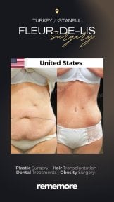 Before and after Fleur-de-Lis surgery results at Memorial Ankara Hospital, body contour improved