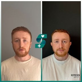 before-after photo otoplasty-ear-surgery