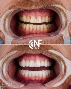 before-after photo implant-bridge