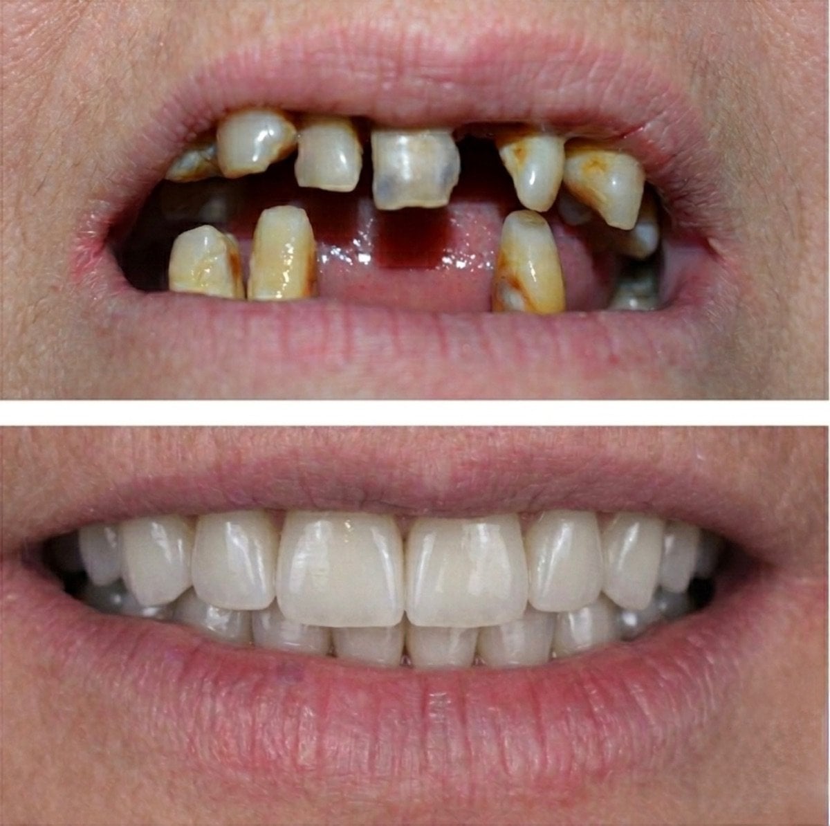 Resultado antes y después de implantes All-on-4 en Spanderashvili Dental Clinic, sonrisa restaurada