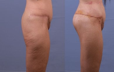 Результати до та після Brazilian Butt Lift у клініці Dr. Safa Manav, покращений контур сідниць