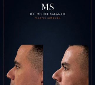 before-after photo blepharoplasty-eyelid