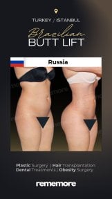 before-after photo 360-liposuction