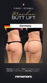 before-after photo 360-liposuction