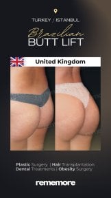 before-after photo 360-liposuction