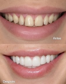 Before and after dental veneers results – whiter, even smile transformation