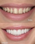 Before and after dental veneers results – whiter, even smile transformation