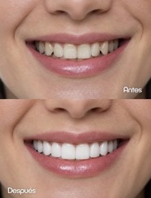 Before and after dental implant results – improved smile aesthetics and whiter teeth