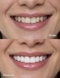 Before and after dental implant results – improved smile aesthetics and whiter teeth