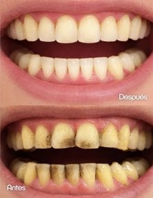 Before and after dental veneers result – whiter, cleaner teeth after treatment