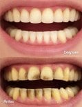 Before and after dental veneers result – whiter, cleaner teeth after treatment