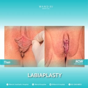 Before and after labiaplasty results at Wansiri Hospital – improved labia appearance