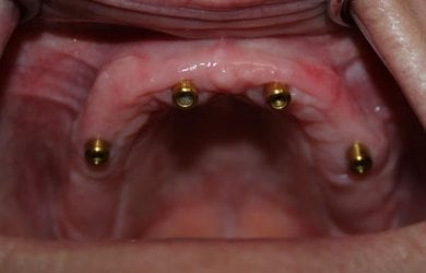 Upper jaw dental implants for denture placement at SoftDentalCare Clinic, treatment result