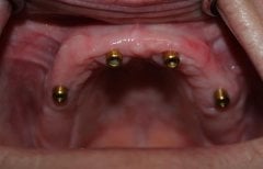 Upper jaw dental implants for denture placement at SoftDentalCare Clinic, treatment result