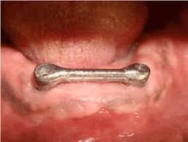 Bar-retained denture placement result at SoftDentalCare Clinic, visible implant support