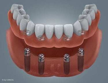 Denture on dental implants result at SoftDentalCare Clinic, secure full arch restoration