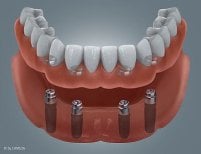 Denture on dental implants result at SoftDentalCare Clinic, secure full arch restoration