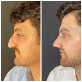 نتائج تجميل الأنف قبل وبعد في Quartz Hospital، تحسين شكل الأنف والملف الجانبي