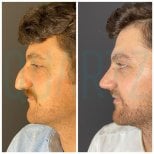 نتائج تجميل الأنف قبل وبعد في Quartz Hospital، تحسين شكل الأنف والملف الجانبي
