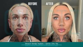 Before and after cheekbone implant and midface lift results at Quartz Hospital, 42 days post-op