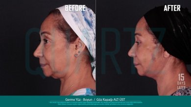 Before and after facelift and neck lift results at Quartz Hospital, visible facial rejuvenation