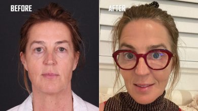 Before and after facelift results at Quartz Hospital, visible facial rejuvenation and smoother skin
