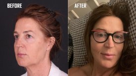 Before and after facelift results at Quartz Hospital, visible facial rejuvenation and smoother skin