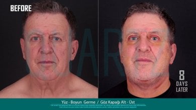 Before and after face and neck lift with eyelid surgery results at Quartz Hospital, 8 days post-op