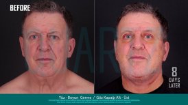Before and after face and neck lift with eyelid surgery results at Quartz Hospital, 8 days post-op