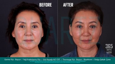 Facelift and facial rejuvenation before and after results at Quartz Hospital, 1 year post-op